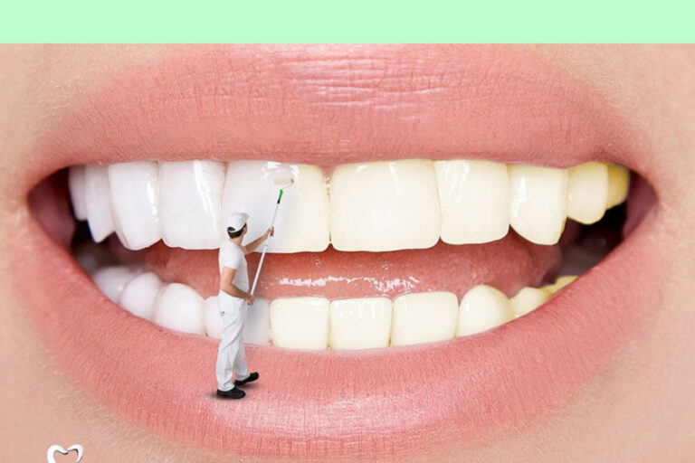 Tay Trang Rang La Gi Nhung Dieu Can Biet Truoc Khi Tay Trang Rang 3