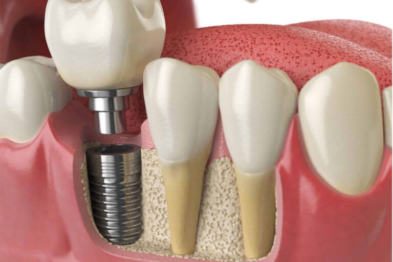 Cay Ghep Implant La Gi Cay Ghep Implant Co Nguy Hiem Khong 1