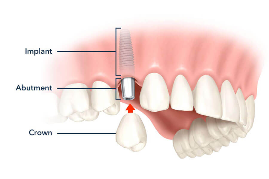 Keo dán răng sứ là gì?