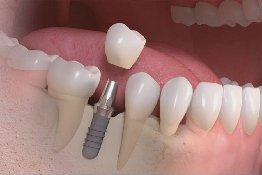 Cay Ghep Implant La Gi Cay Ghep Implant Co Nguy Hiem Khong 3