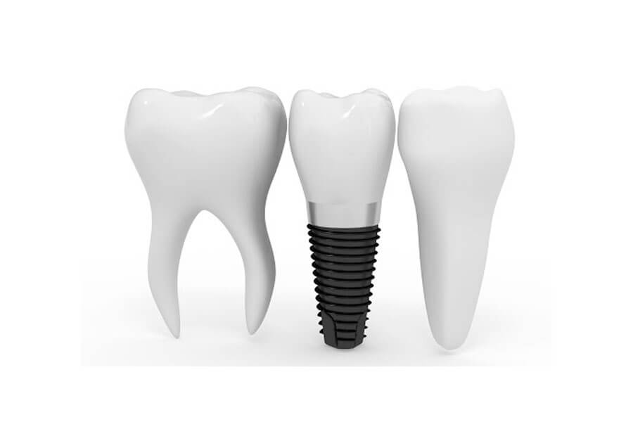 Cay Ghep Implant La Gi Cay Ghep Implant Co Nguy Hiem Khong 4