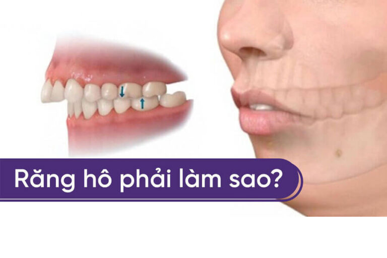 Nieng Rang Nha Khoa Dong A 3