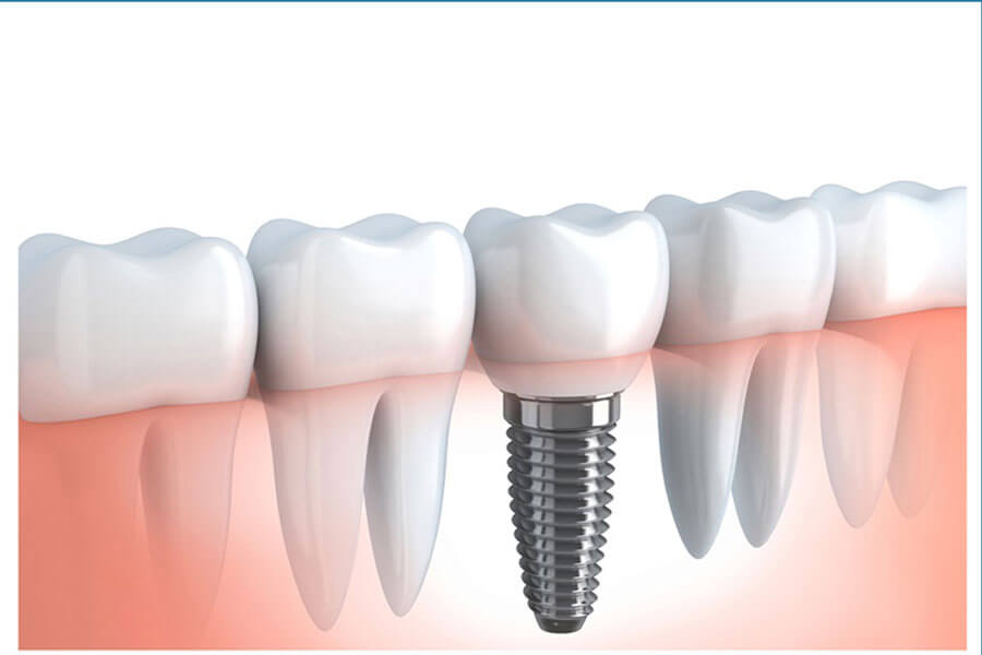 Sau Khi Trong Rang Implant Nen An Gi Va Kieng Gi 5