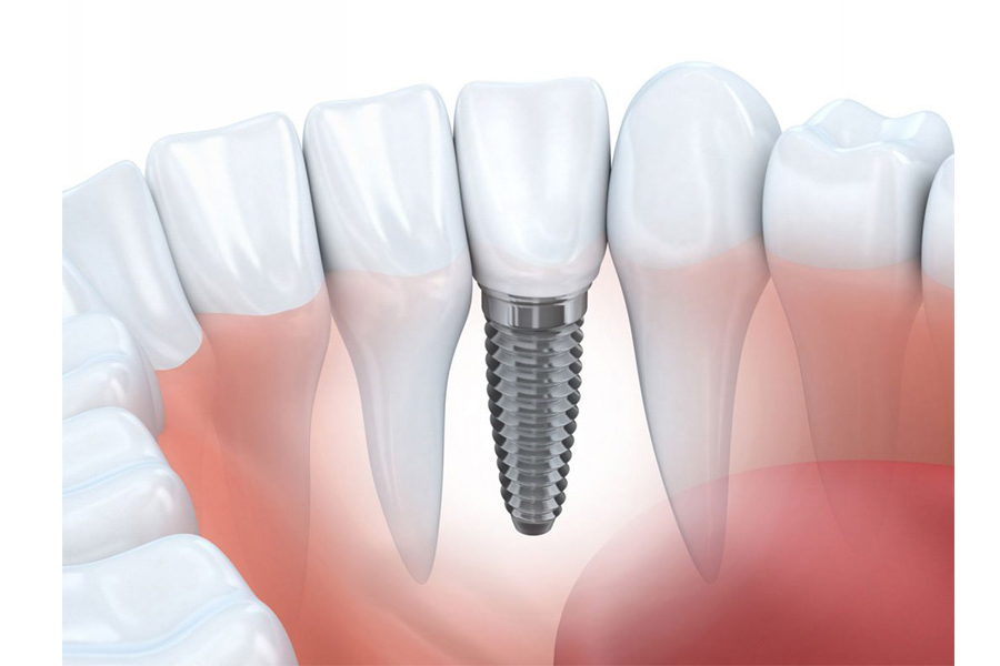 Cấy Ghép Implant Là Gì
