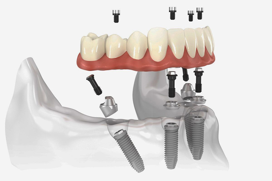 Chi Phí Cấy Ghép Implant