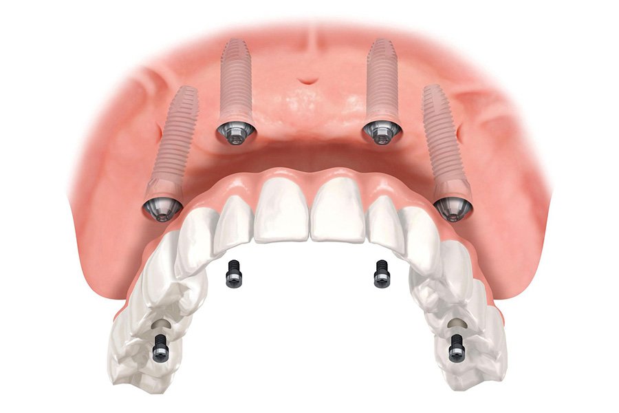 Chi Phi Trong Rang Implant