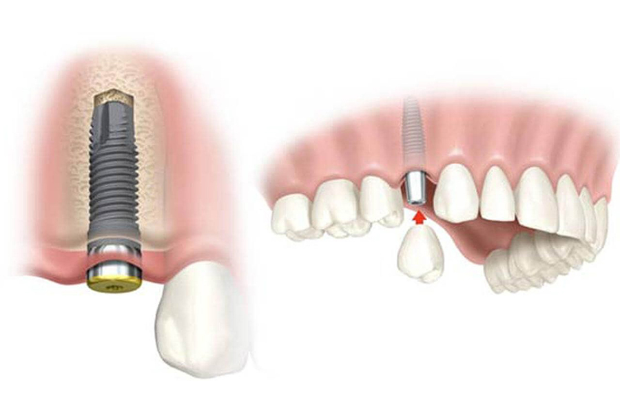 Chi Phí Cấy Ghép Implant