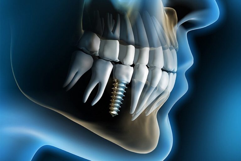 Nhung Bien Chung Khi Thuc Hien Cay Ghep Implant