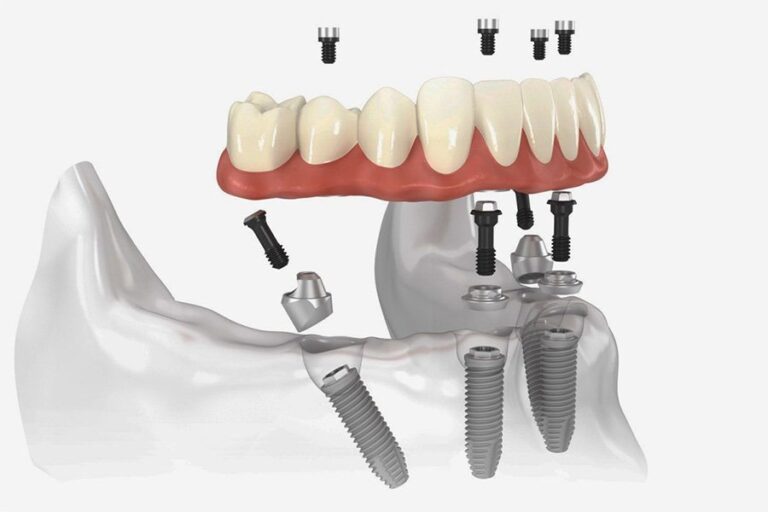 Nhung Cau Hoi Thuong Gap Ve Cay Ghep Implant
