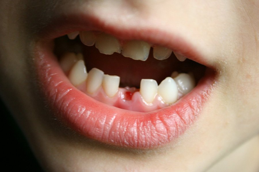 Nhung Nguoi Mat Rang Mat Nhieu Rang Nen Cay Ghep Implant