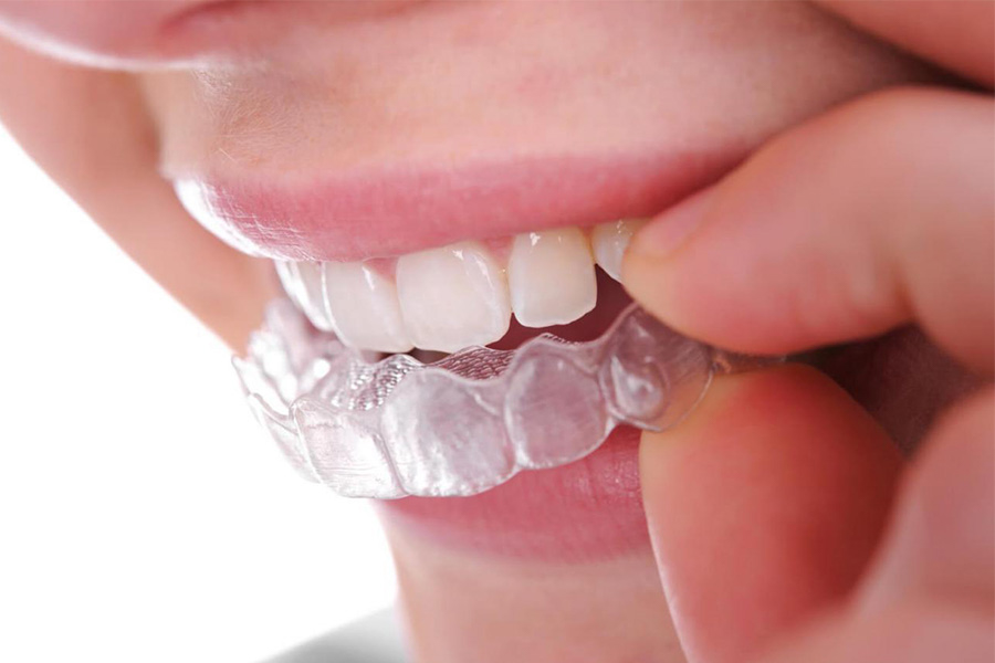 Niềng Răng Không Mắc Cài Là Gì Có Hiệu Quả Không