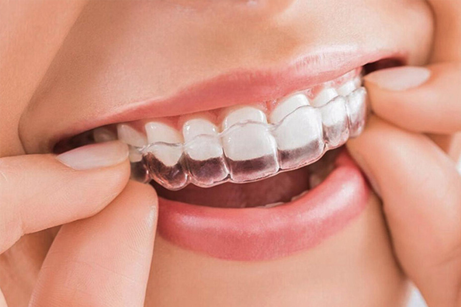 Niềng Răng Không Mắc Cài Là Gì