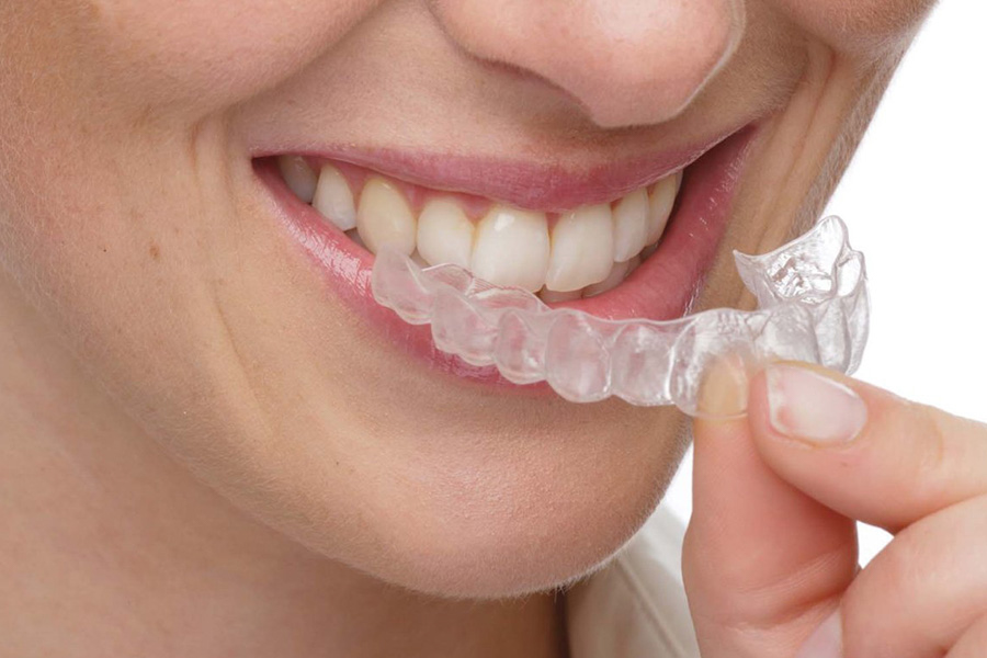 Niềng Răng Không Mắc Cài Tháo Lắp Dễ Dàng