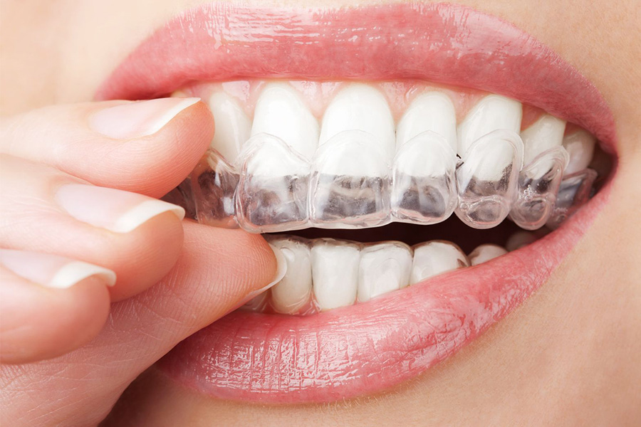 Niềng Răng Trong Suốt Clear Aligner