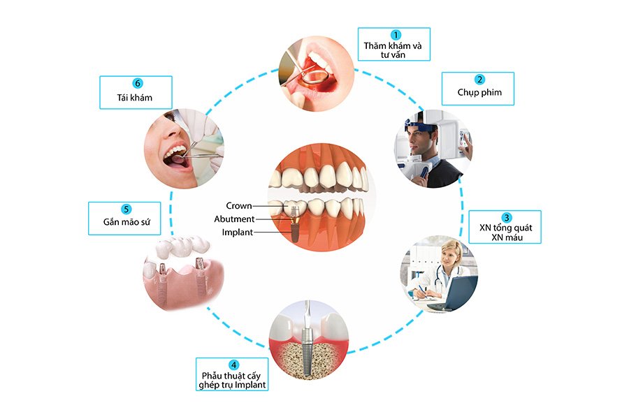 Quy Trinh Cay Ghep Implant Nha Khoa Dong A Phu Nhuan