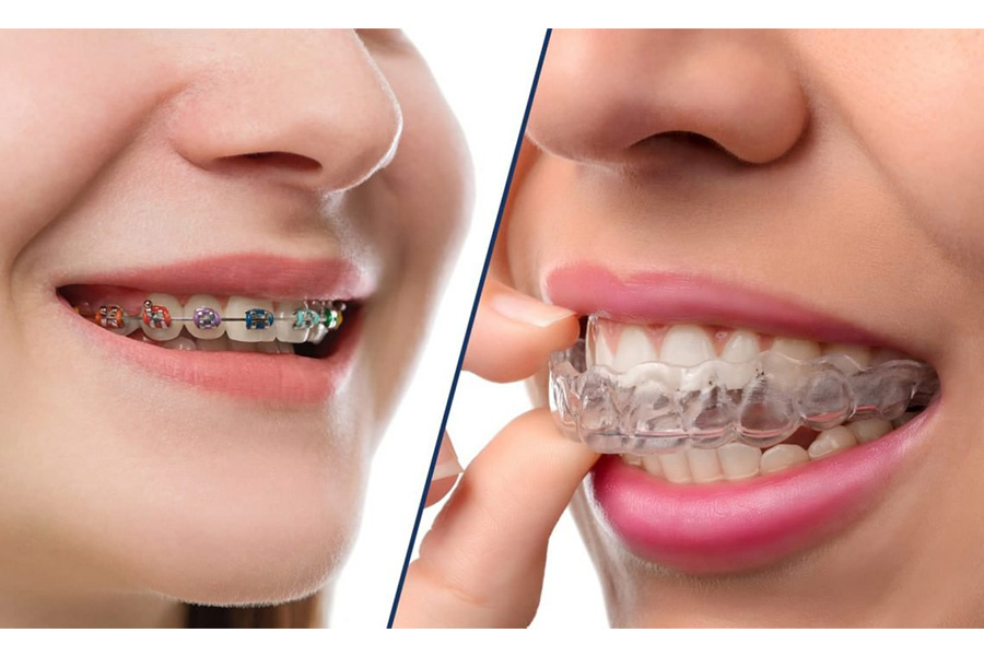 Sự Khác Biệt Giữa Niềng Răng Mắc Cài Và Niềng R