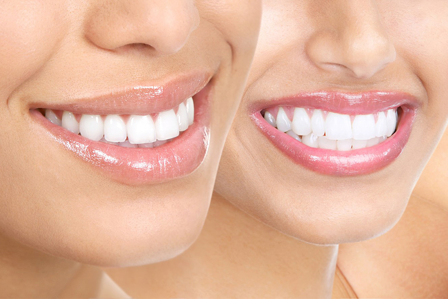 Tại Sao Tẩy Trắng Răng Không Vĩnh Viễn