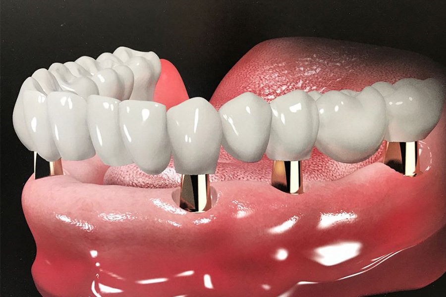 Trong Rang Implant La Gi