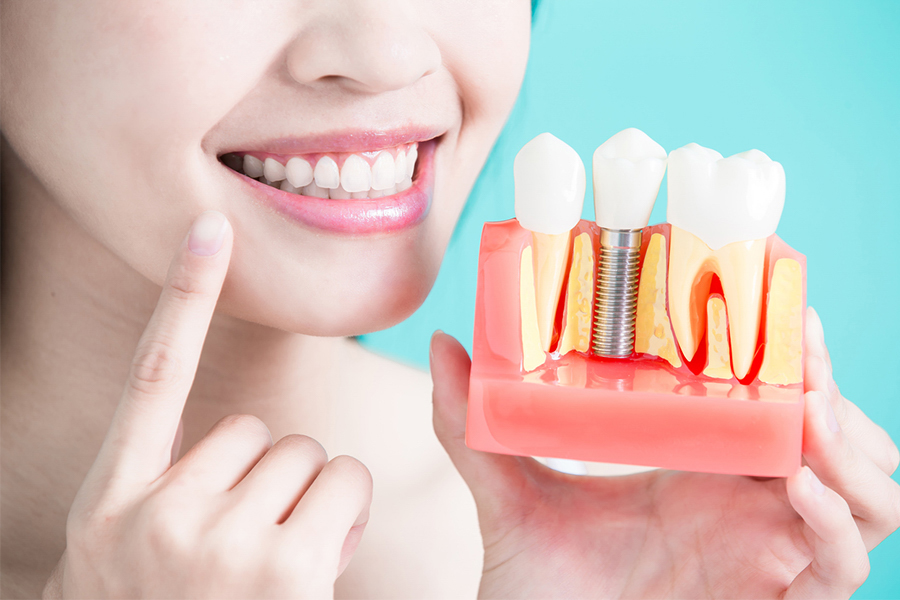 Ưu điểm Của Cấy Ghép Implant