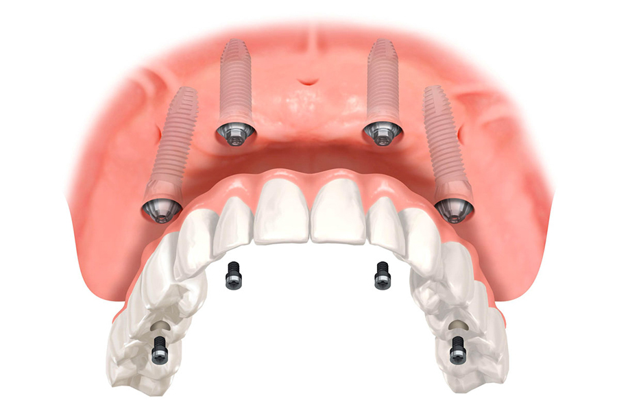Ưu điểm Của Cấy Ghép Implant All On 4