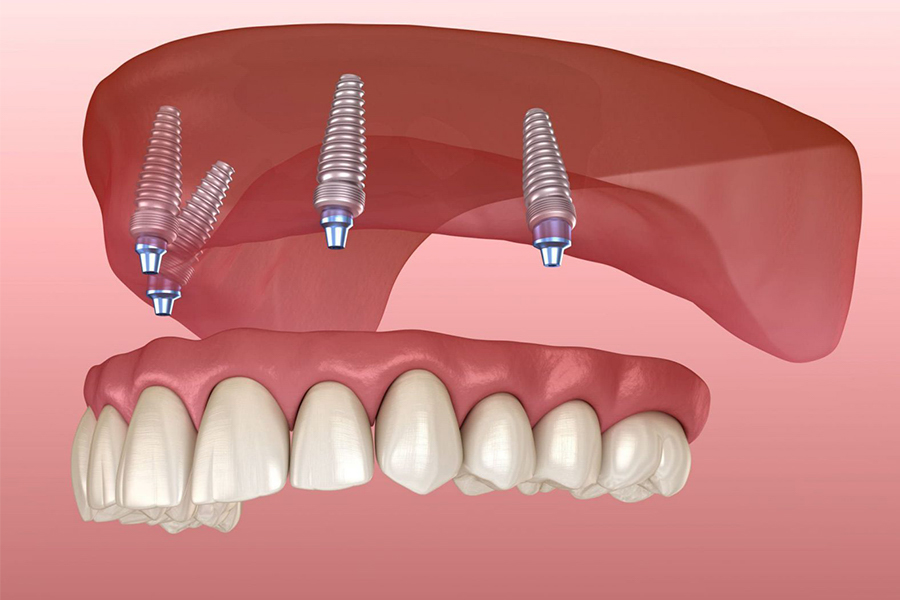 Xương Hàm Không đủ Tiêu Chuẩn Cấy Ghép Implant