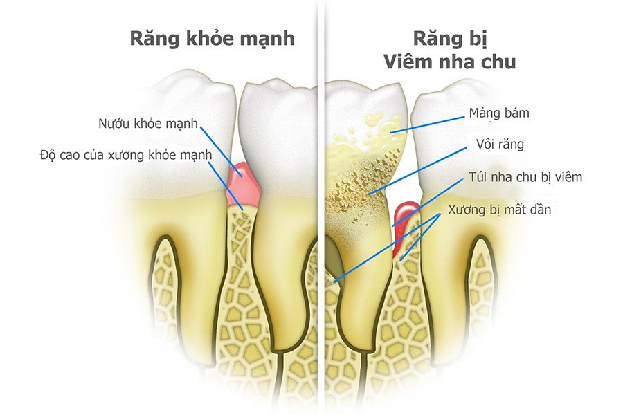 Nguyen Nhan Dan Den Viem Nha Chu