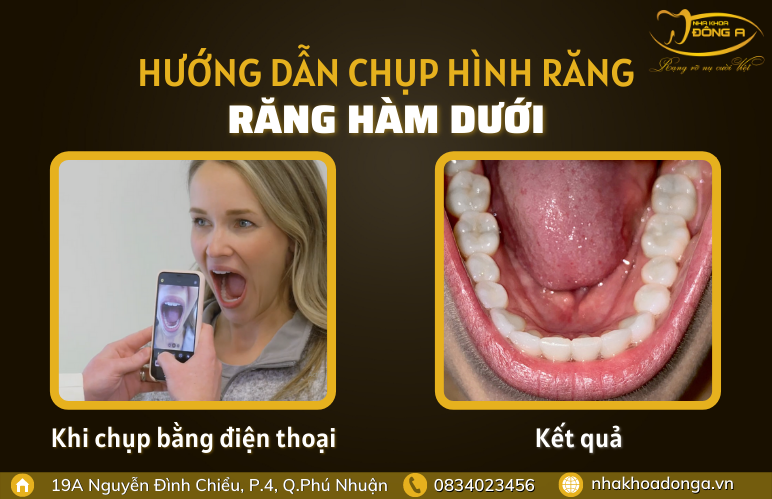 chup-hinh-rang-ham-duoi