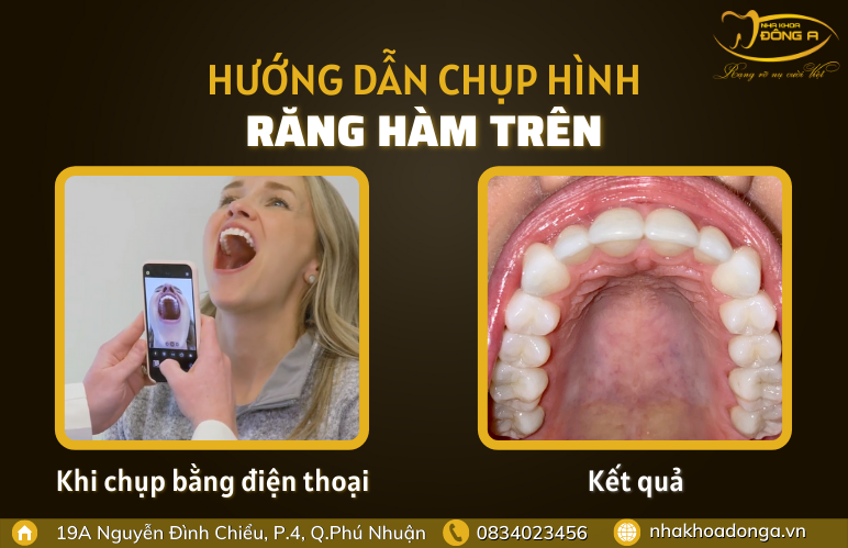 chup-hinh-rang-ham-tren