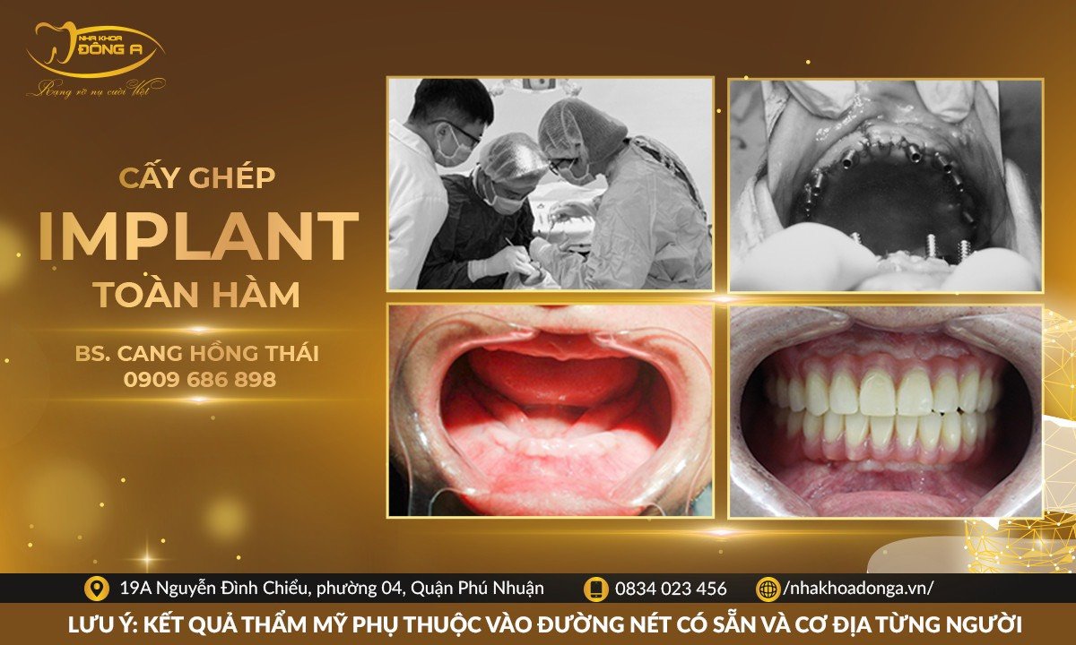 cay-ghep-implant-toan-ham