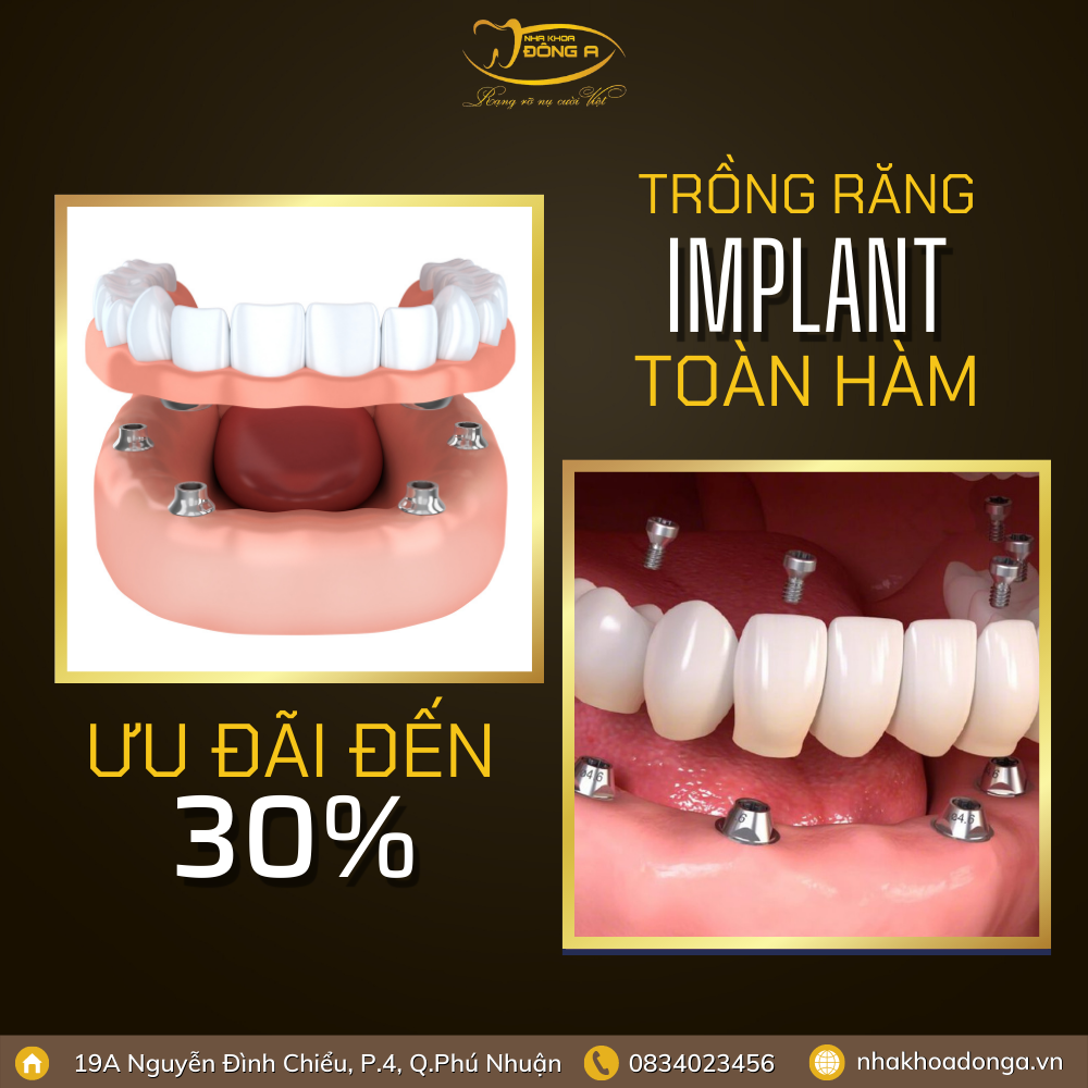 Implant Toan Ham