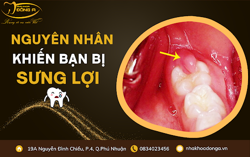 nguyen-nhan-dan-den-sung-loi-trong-cung