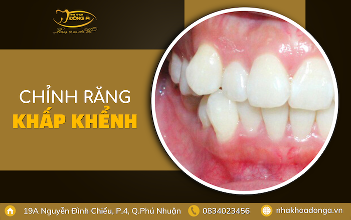 chinh-rang-bi-khap-khenh