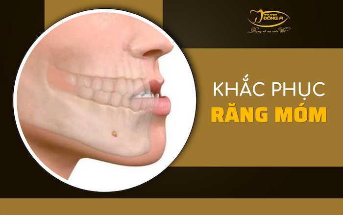 khac-phuc-rang-mom