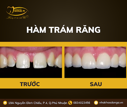 Rang Cua Thua Phai Lam Sao 1