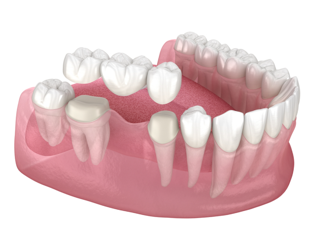 Nhược điểm cầu răng sứ