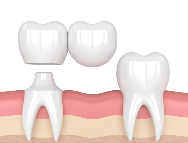 Cầu răng sứ có bền không