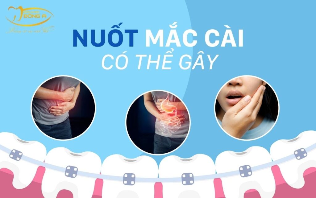 nuốt mắc cài