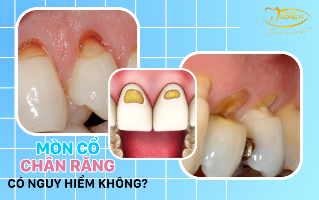 mòn cổ chân răng