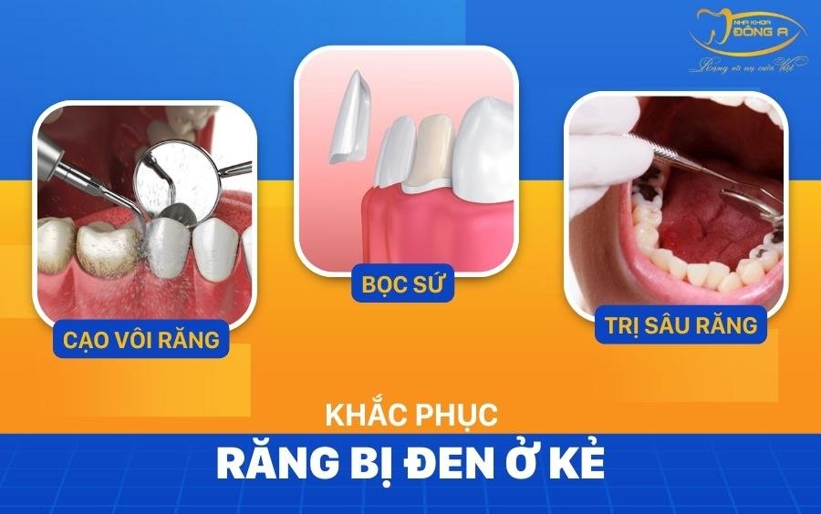 Điều trị răng bị đen ở kẽ