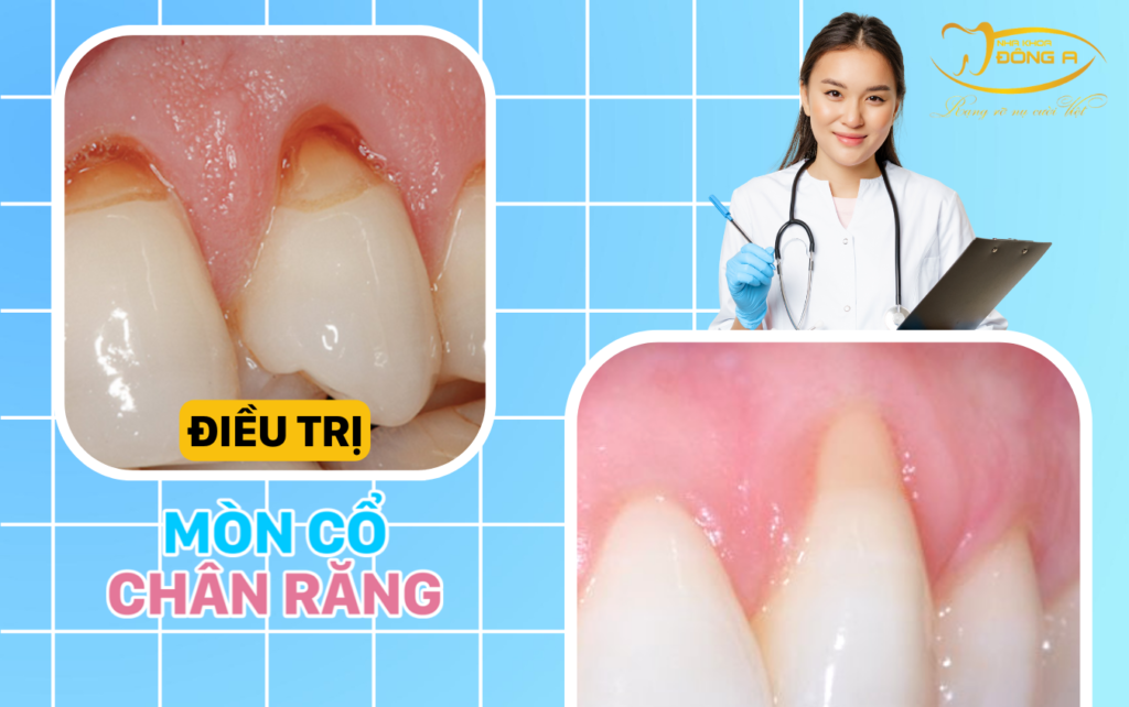 mòn cổ chân răng