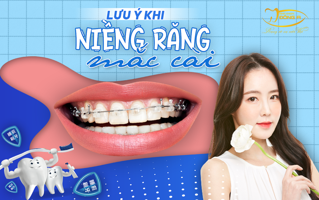 luu-y-khi-nieng-răng-mac-cai-kim-loai