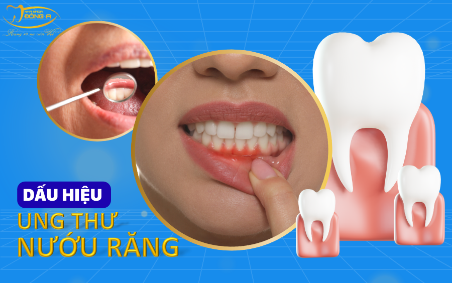dau-hieu-nhan-biet-ung-thu-nuou-rang