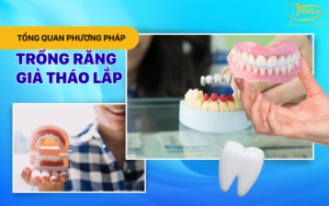tong-quan-phuong-phap-trong-rang-gia-thao-lap