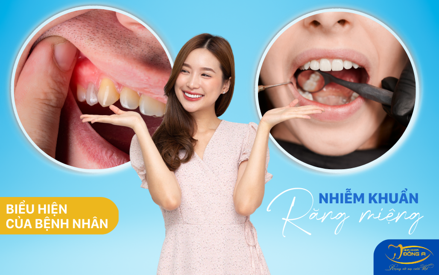 bieu-hien-cua-benh-nhan-nhiem-khuan-rang-mieng