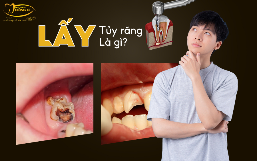 lay-tuy-rang-la-gi