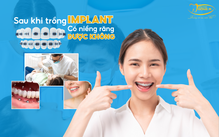 Sau khi trồng Implant có niềng răng được không