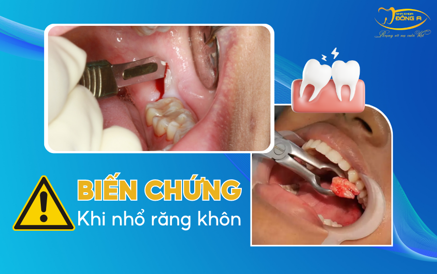 bien-chung-cua-rang-khon