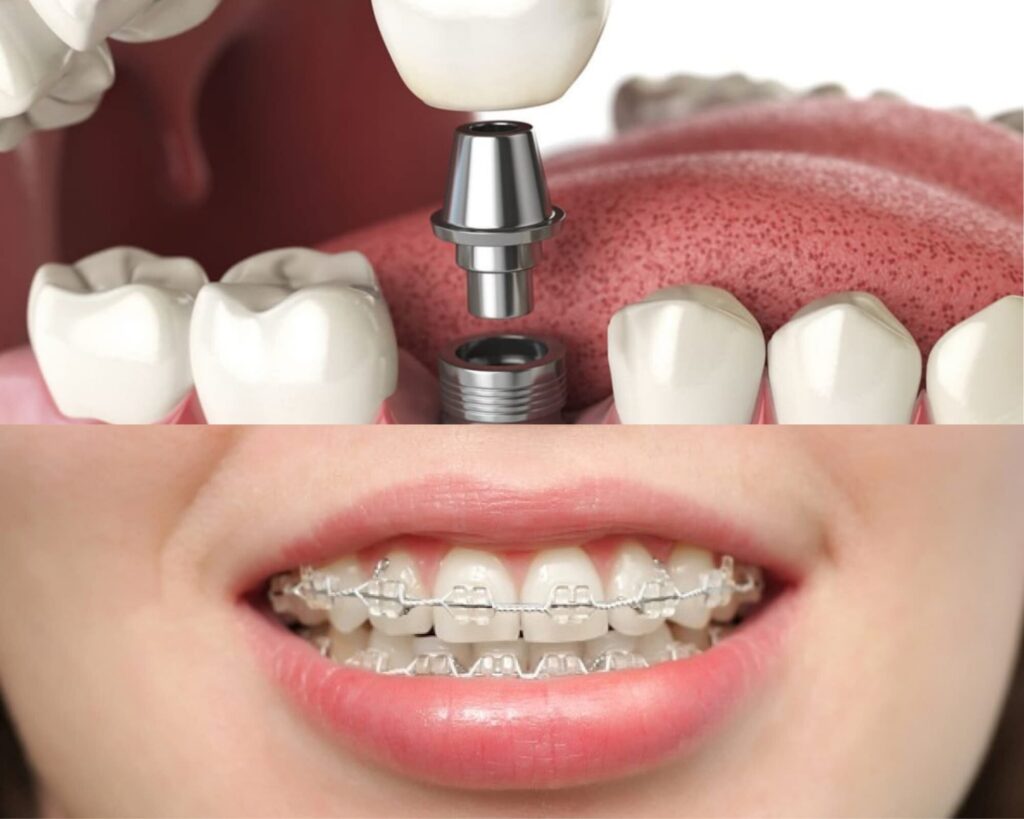 Trồng Implant có thể niềng răng được không