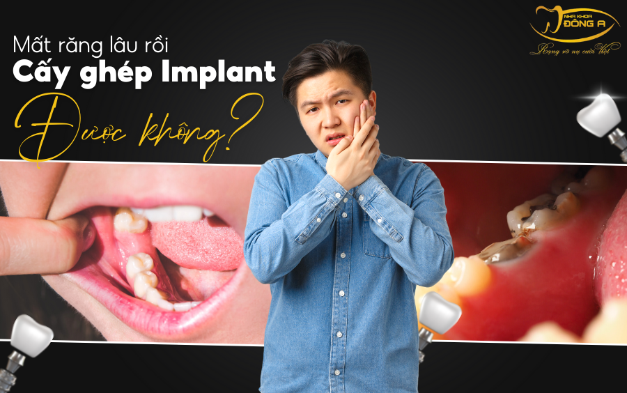trong-rang-implant-qua-tre