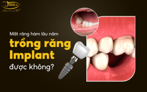 rang-implant